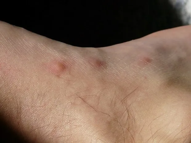Kousnutí štěnice na lidské kůži s červenými pupínky.