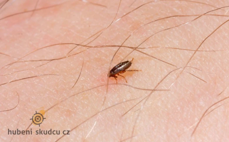 Blecha na lidské kůži mezi vlasy.