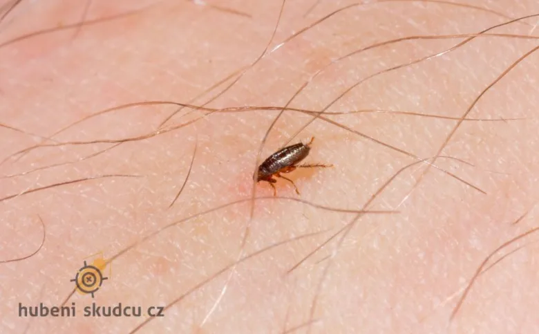 Blecha na lidské kůži s chlupy v makro záběru.