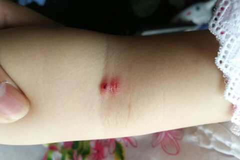 Kousnutí štěnice na kůži paže s zarudlým otokem.